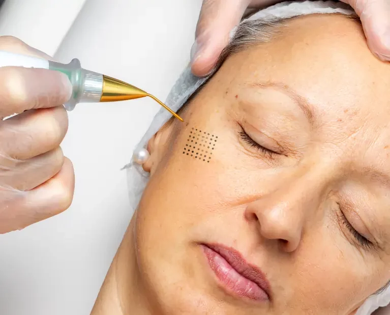 Plasmapen Anti-Aging Behandlung in Mannheim - Kosmetiklounge Kosmetikstudio